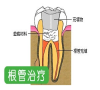 深圳牙科-三康口腔-根管治療有什麽用？