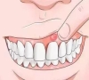 牙齦炎有以下症狀？深圳牙醫建議儘早治療干預