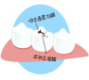 三康口腔，食物嵌塞牙齒是什麽原因？應及時到深圳牙科診治
