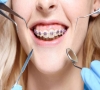 牙齒矯正顧客選擇隱適美隱形矯正的6個原因？