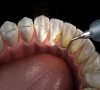 洗牙之後牙齒很敏感怎麼辦？怎麼處理好？