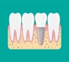 深圳牙齒矯正-牙齒問題影響外貌：齙牙和“地包天”