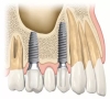 種植牙的組成部分及種植牙週期？—深圳牙科