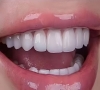 深圳牙齒美白推介？邊種美牙效果更好？