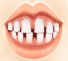 深圳牙科三康口腔-導致牙齒矯正失敗的原因竟然是它？！