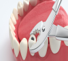牙齒鬆動係咩原因？需要拔牙嗎？