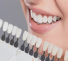 港人到深圳做牙齒美白通常做幾次比較好？可以維持幾耐？