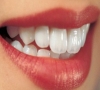 牙齒美白貼面好嗎？