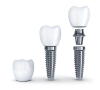 種植牙分為幾個療程？深圳植牙口腔推介？