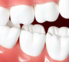 深圳牙齒貼面價格收費幾錢？樹脂貼面和瓷貼面有什麼區別？