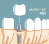 深圳種植牙-關於種植牙的即刻負重和漸進負重有什麼區別？