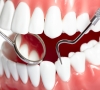 深圳專業牙醫告訴你怎麽預防齲齒？