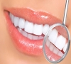 深圳牙齒美白-冷光美白的具體過程是什麼樣的？