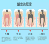 點解後牙會有齲洞？深圳三康口腔補牙幾錢？