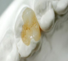 在深圳用嵌體補牙能維持多久？和傳統的補牙有什麽不同？