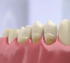 牙結石對牙齒有咩危害？洗牙可唔可以緩解？