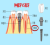 深圳種牙-怎樣才能種牙的使用很長久呢？