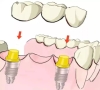 深圳種植牙-牙齒缺失，為什麼醫生不建議做種植牙？