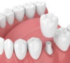 深圳牙醫教點樣區分優質牙冠？牙冠壞佐點算好？