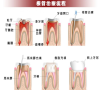 深圳要做根管治療的話使用壽命有多久？