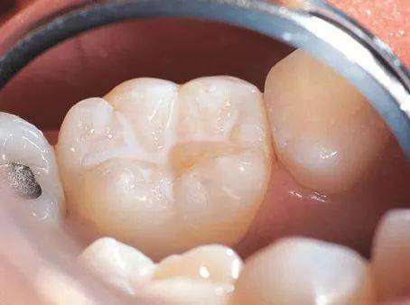 深圳牙齿窝沟龋治疗