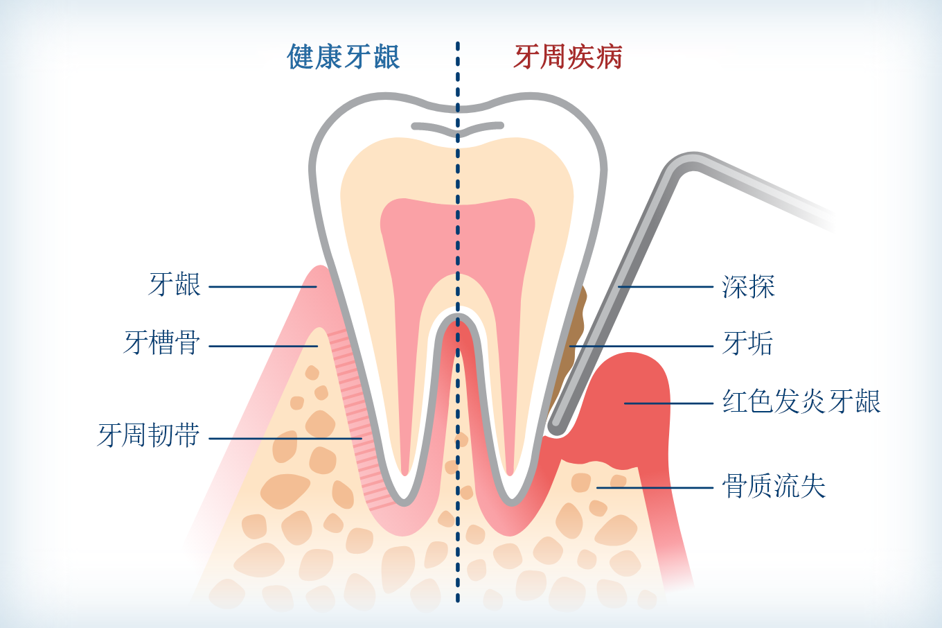 牙周病有哪一些危害？深圳牙周病治療方法介紹？