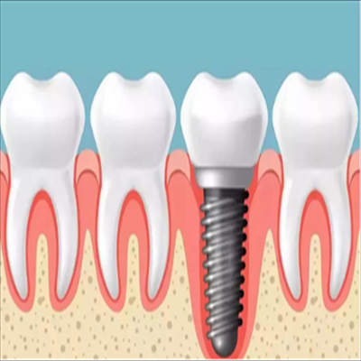 深圳植牙