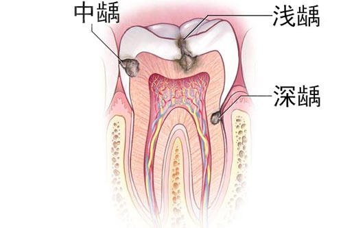 杜牙根、牙齿深龋