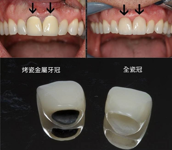 烤瓷牙冠和全瓷牙冠