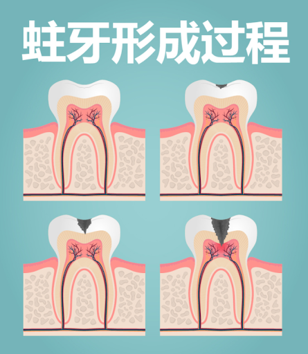 牙齒大牙齲洞發痛點算？深圳杜牙根推介？