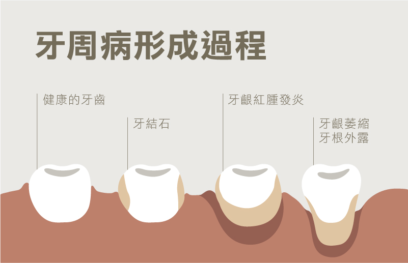 深圳三康牙科牙周病治療