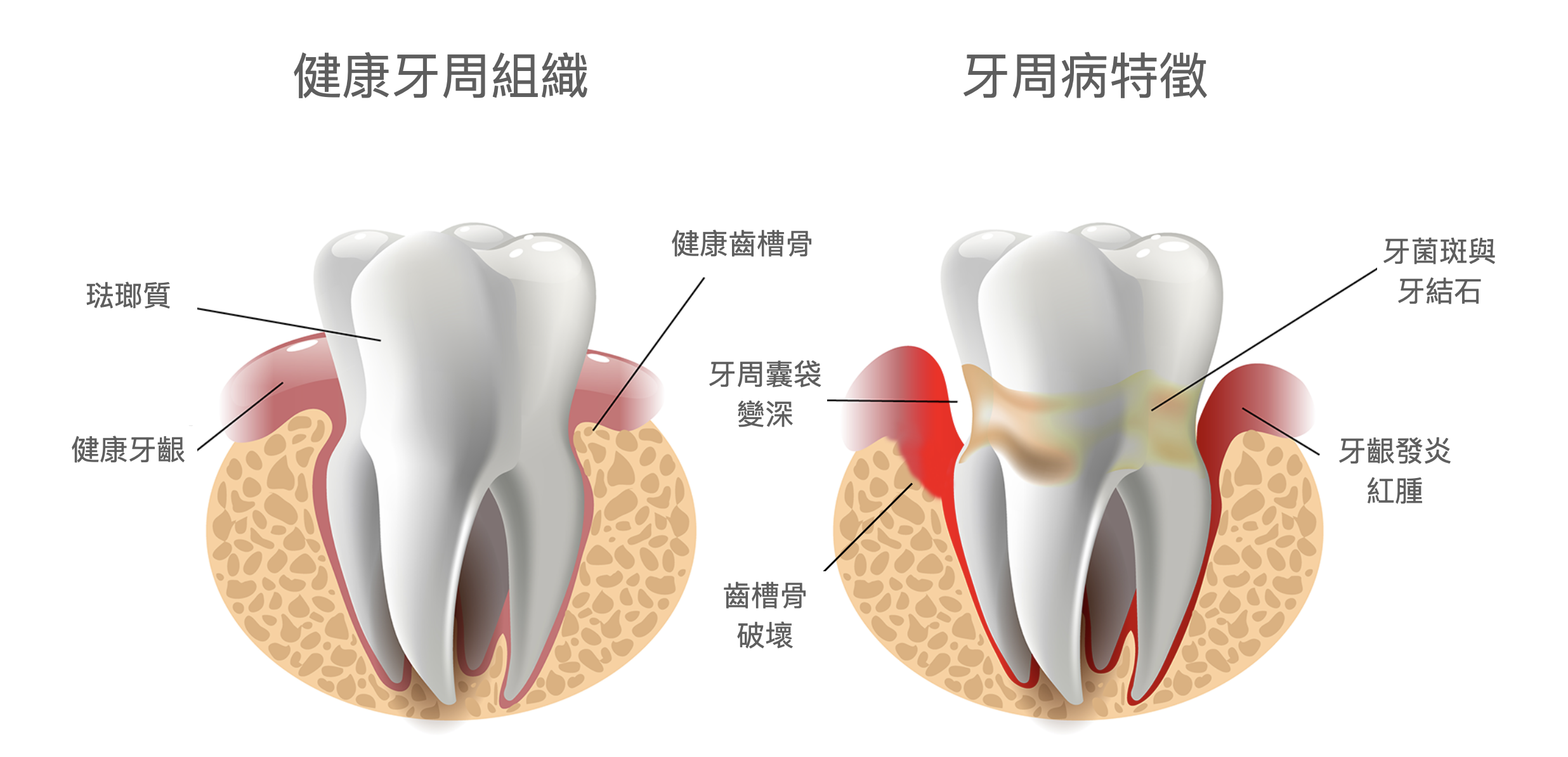 深圳三康口腔牙周病治療