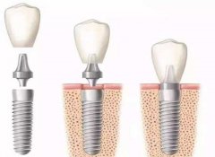 牙齒缺失可以通過什麼方式修復呢？