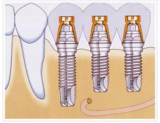 種植牙是什麼？