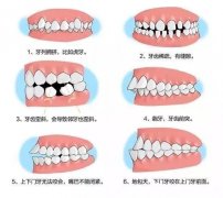 深圳箍牙科普-咩情況會導致牙齒唔齊咧？