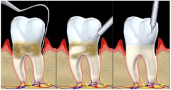 怎樣維護牙周病治療的療效