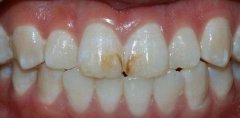 產生頑固性黃牙的原因，怎麼樣才能預防牙齒變