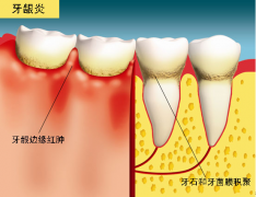 【深圳箍牙科普】患有牙周疾病可以箍牙嗎？