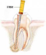 為什麼牙疼非常劇烈？牙痛是不是病