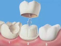 深圳牙冠修復-鑲牙為什麼要磨牙？