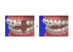 深圳箍牙科普-為什麼有些人說箍牙後牙齒會鬆動