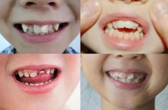 為什麼孩子乳牙長得很整齊，換牙後有些會變得不整齊呢？